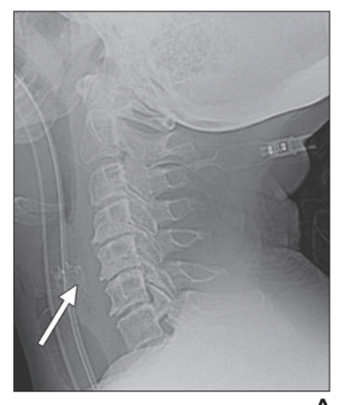 wire grill brush in throat